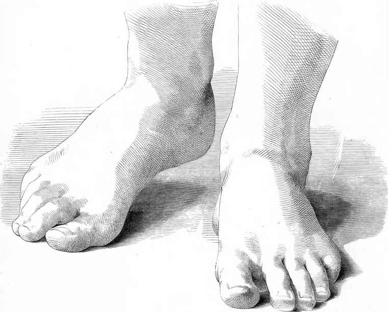 Pédicure podoglogue - soin des pieds